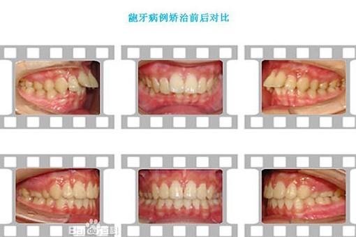 龅牙矫正前后对比图